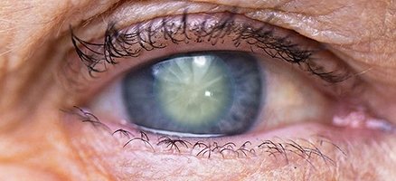 Лікування катаракти