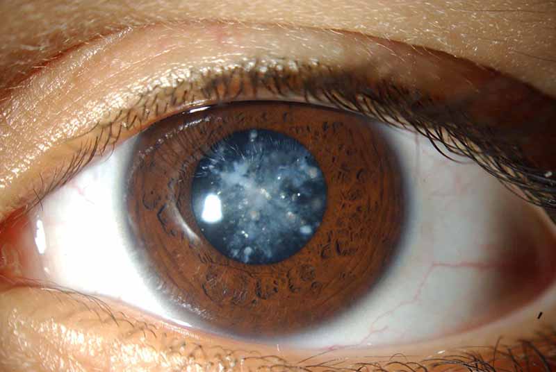 Лікування катаракти
