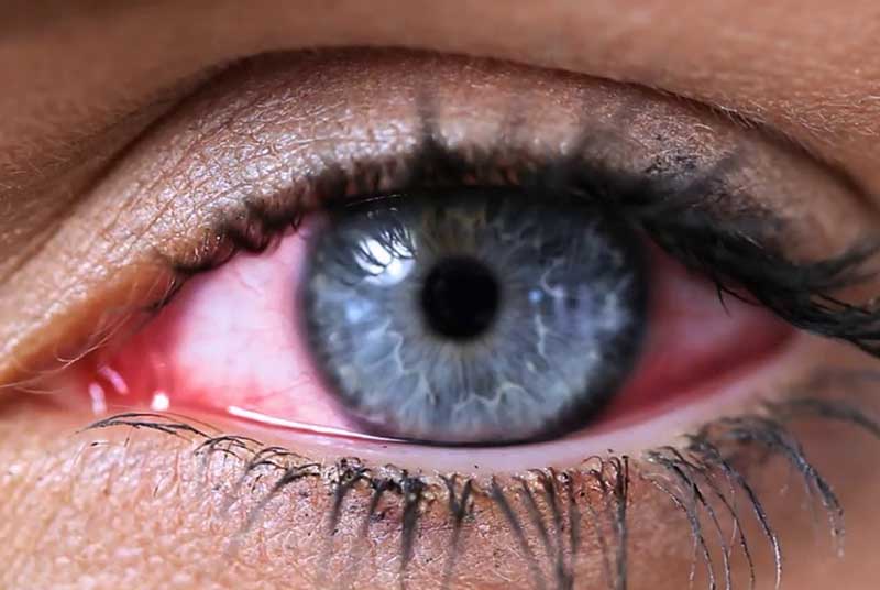 Лечение синдрома «сухого глаза»